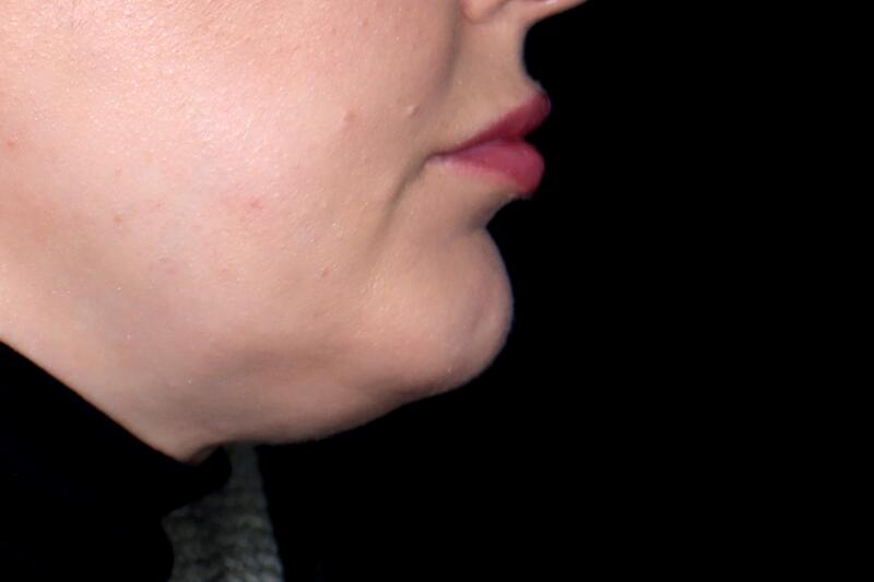 Lip Filler Before & After Image